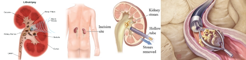 Litíase renal